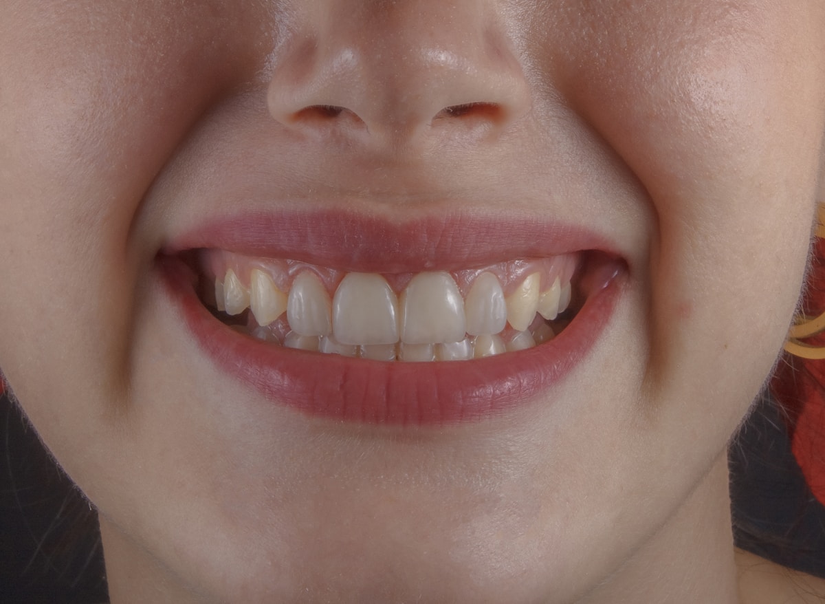 Smile Makeover